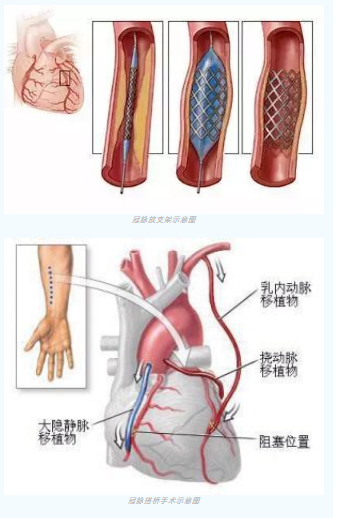 魚與熊掌不可兼得？冠脈雜交手術(shù)一站式解決問題