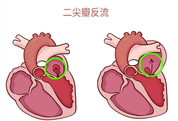 體檢報告里的心臟瓣膜返流，你讀懂了嗎？