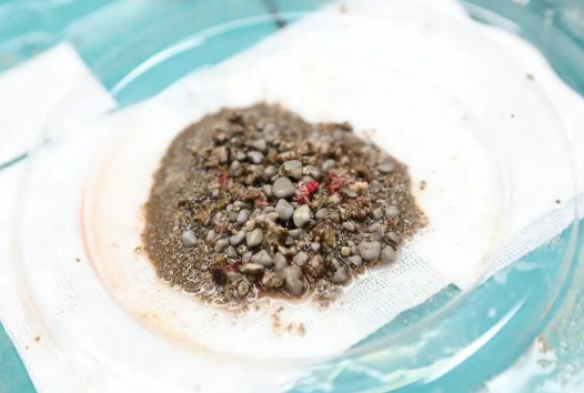 密集恐懼癥慎入！男子腎臟里取出上萬(wàn)顆沙石